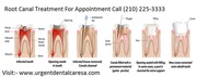Root Canal Treatment  in San Antonio